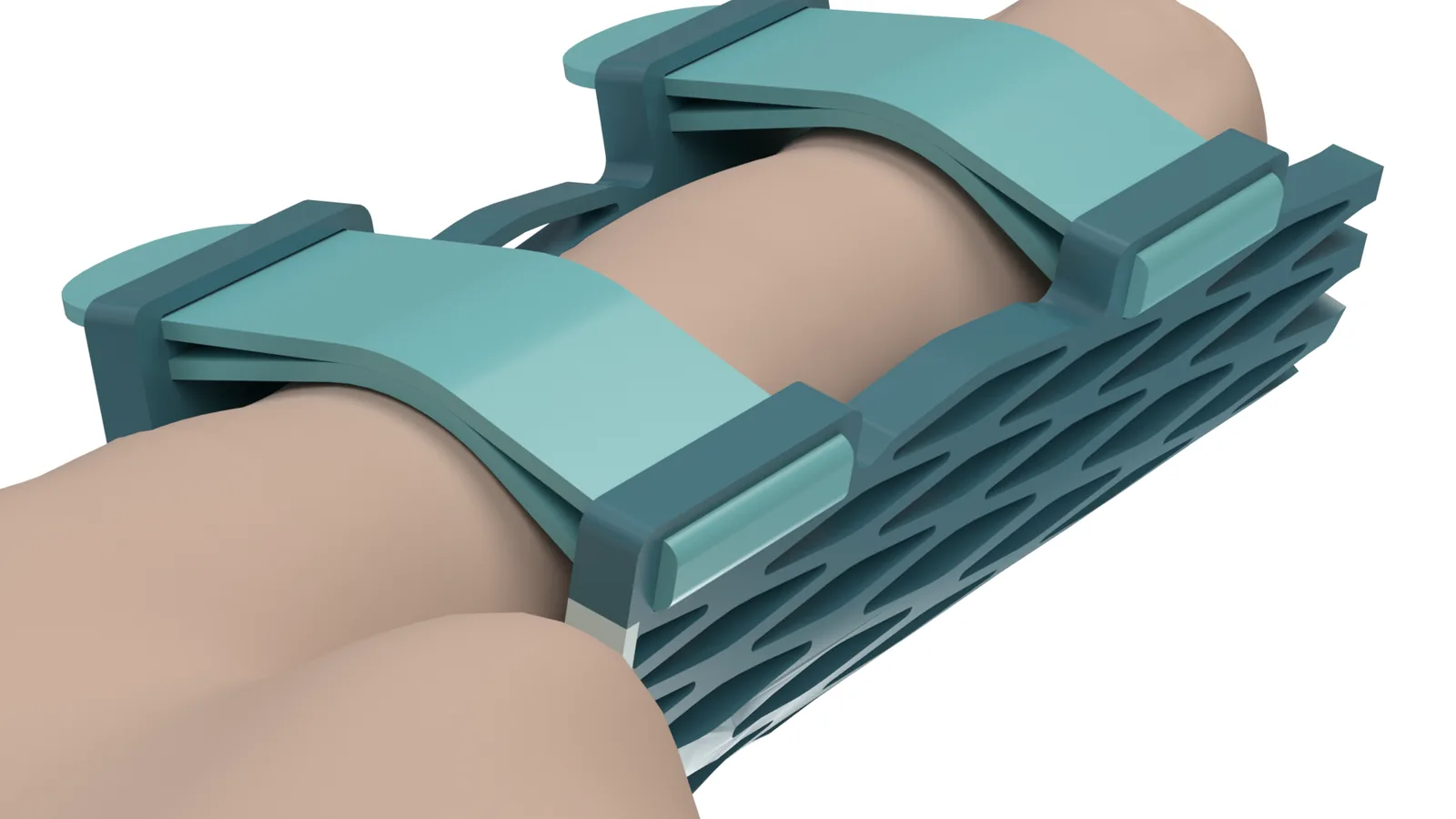 Close view of the Struxaform™ Full-Finger Splint worn on a finger, showing the straps and lattice at the contact area