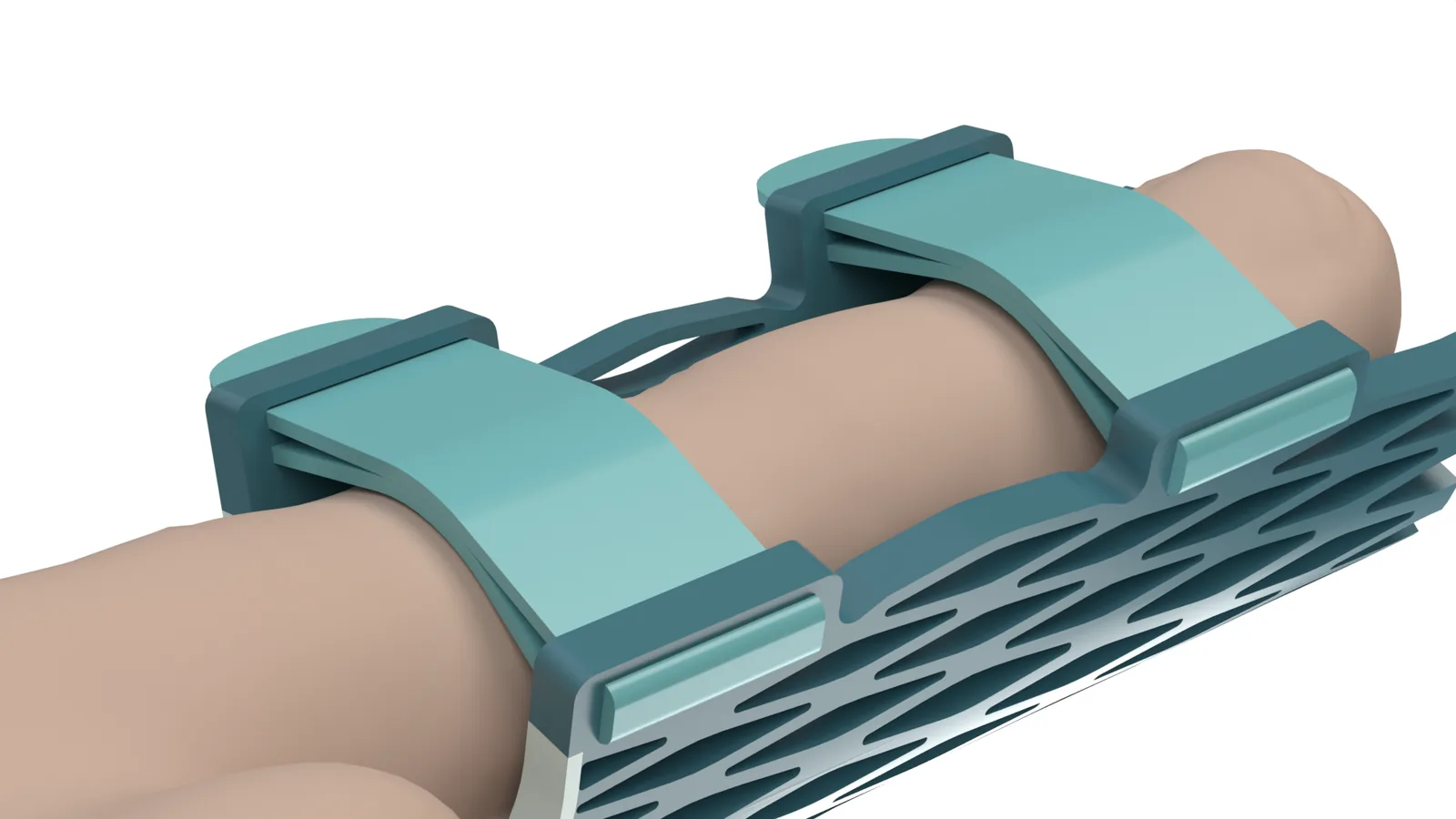 Detail of a strap routed across the lattice of the Struxaform™ Full-Finger Splint, worn on a hand