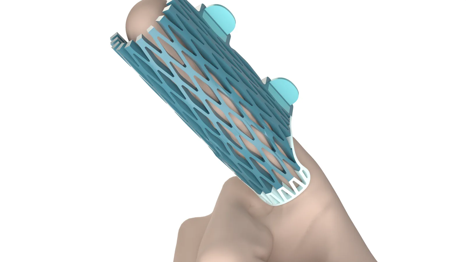 Palm-side view of the Struxaform™ Full-Finger Splint at the base knuckle of a hand