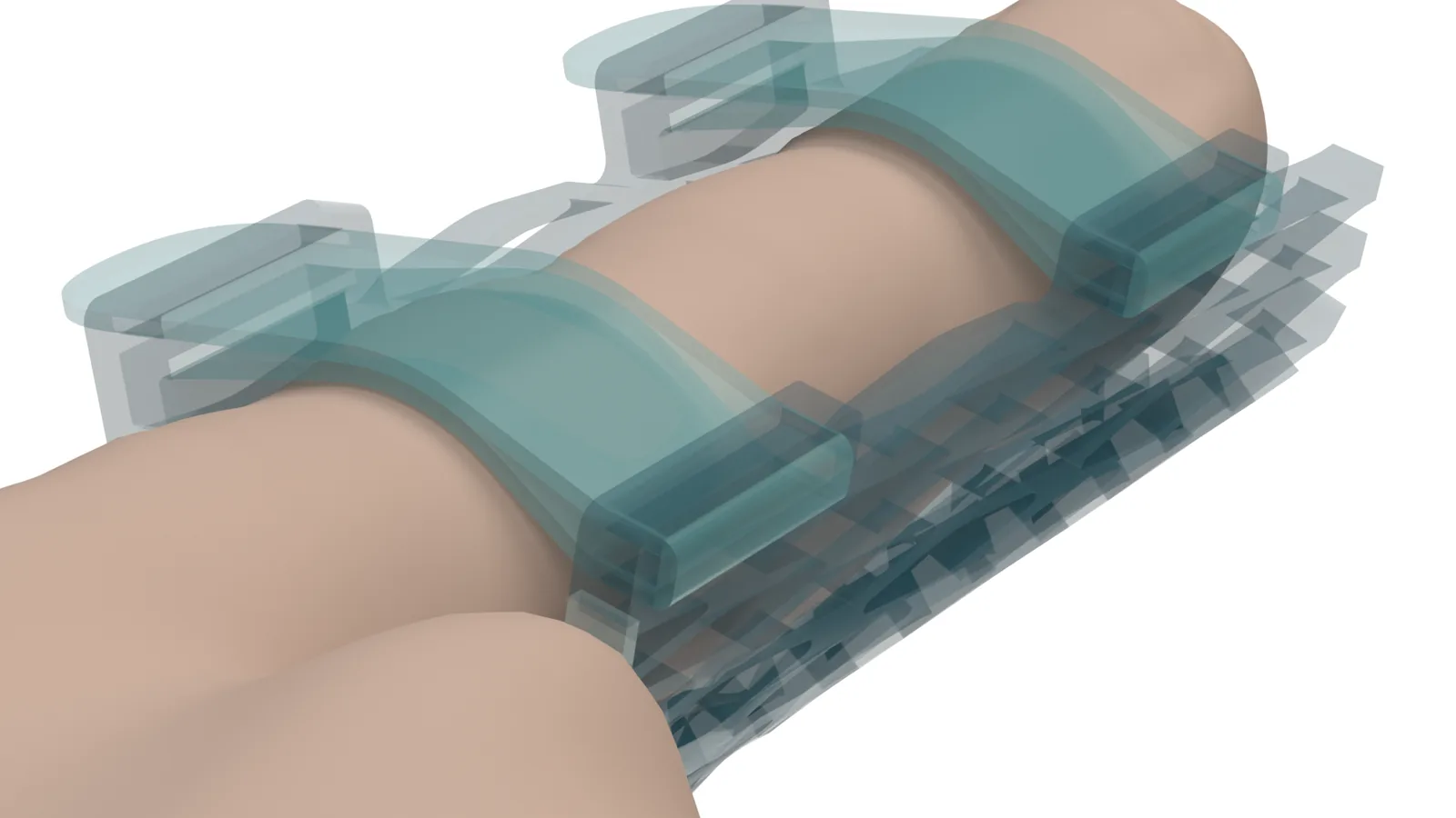 X-ray style close view of the Struxaform™ Full-Finger Splint on a finger, its lattice paths visible through the translucent surface
